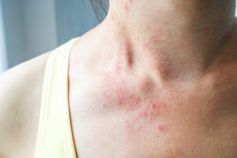 Unser Immunsystem als Allergie-Auslöser